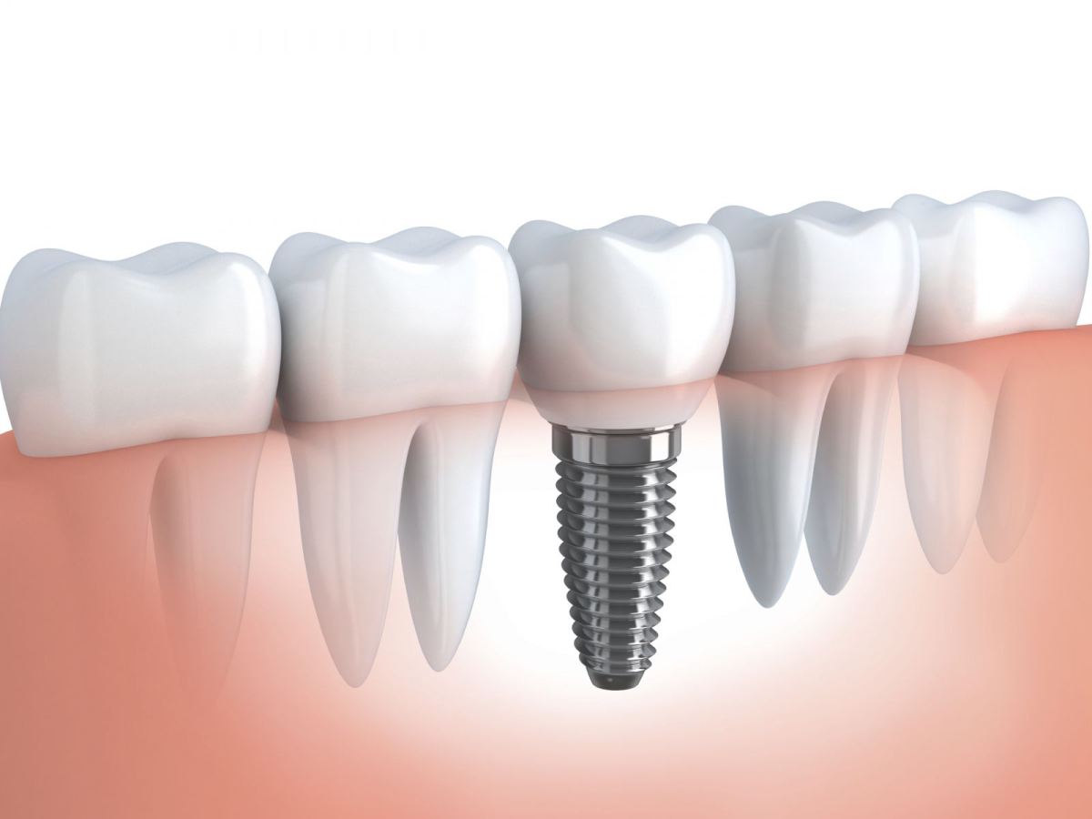 Cấy ghép răng implant có đau không ?