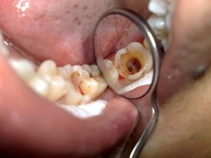 Điều trị tủy răng 