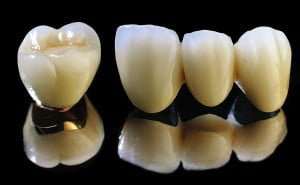 Răng sứ titan có độ bền 15 năm