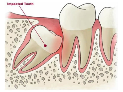 Thông tin về đau răng khôn nguyên nhân và triệu chứng