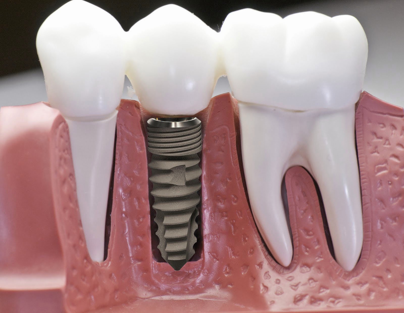 Làm răng implant giá bao nhiêu ?