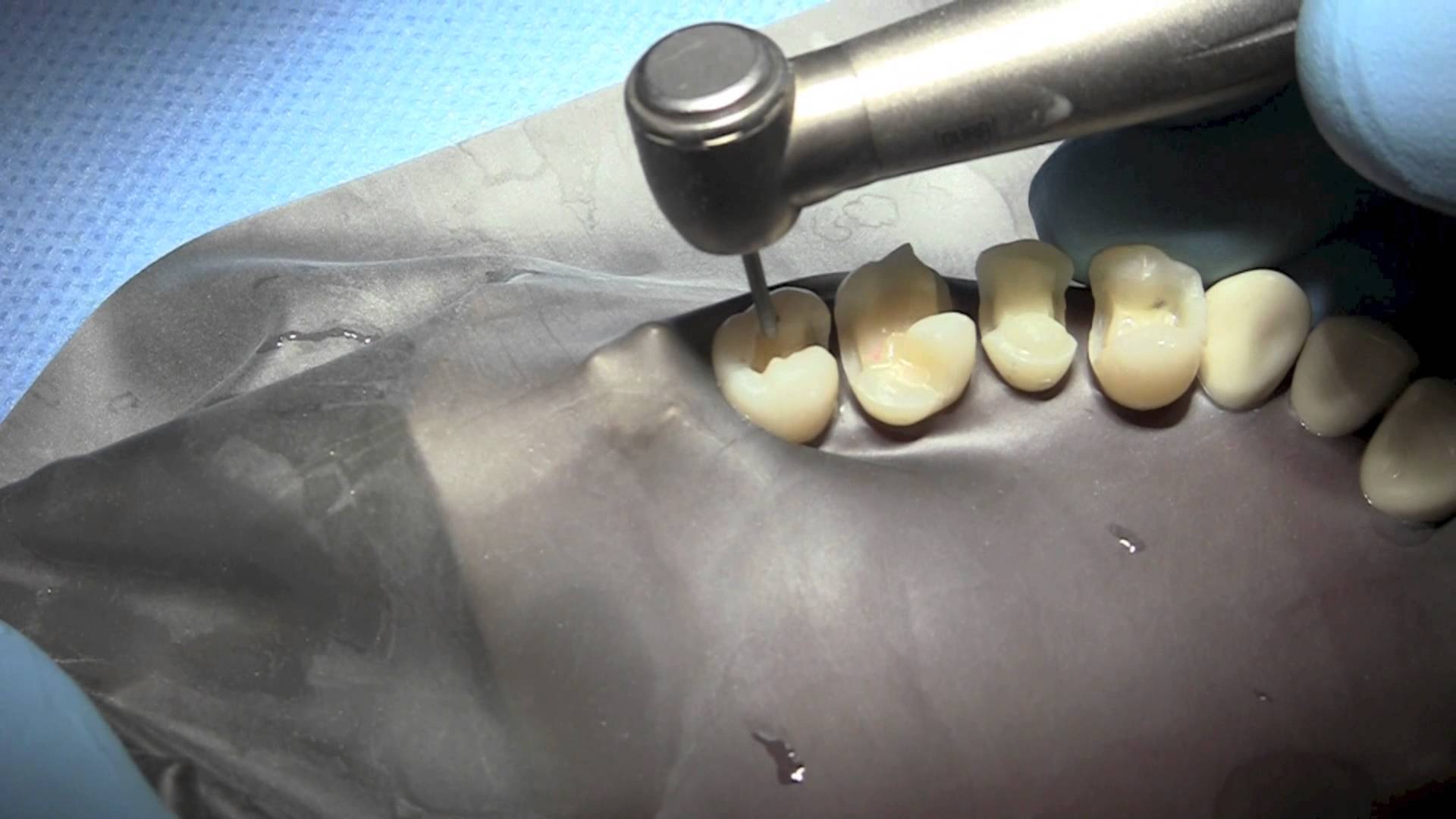 Hàn răng bằng sứ được thực hiện như thế nào ?