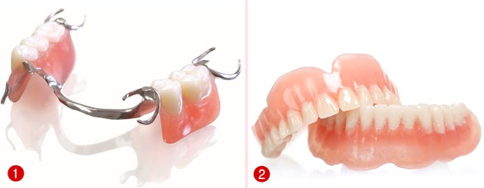 Kỹ thuật trồng răng sứ nào tốt nhất khi bị mất răng