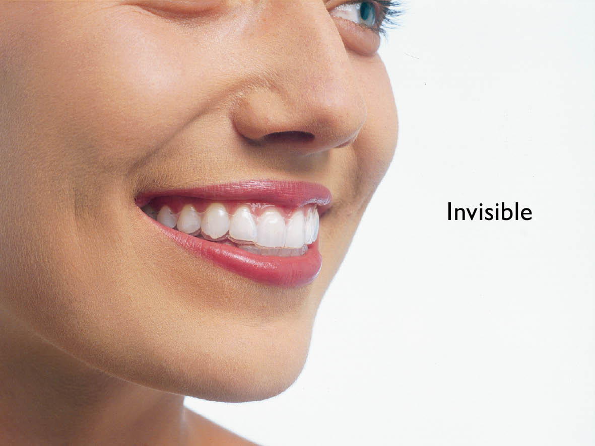 Quy trình niềng răng bằng khay Invisalign
