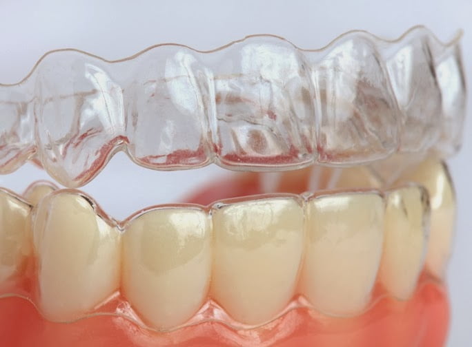 Ưu điểm của phương pháp niềng răng thẩm mỹ Invisalign