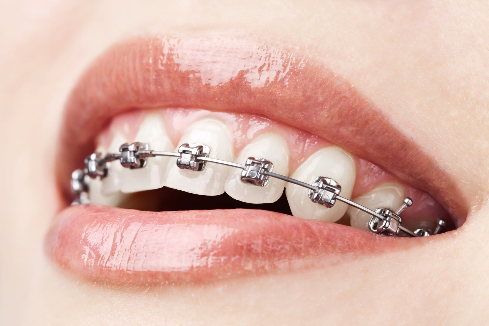 Quy trình niềng răng thẩm mỹ mắc cài kim loại