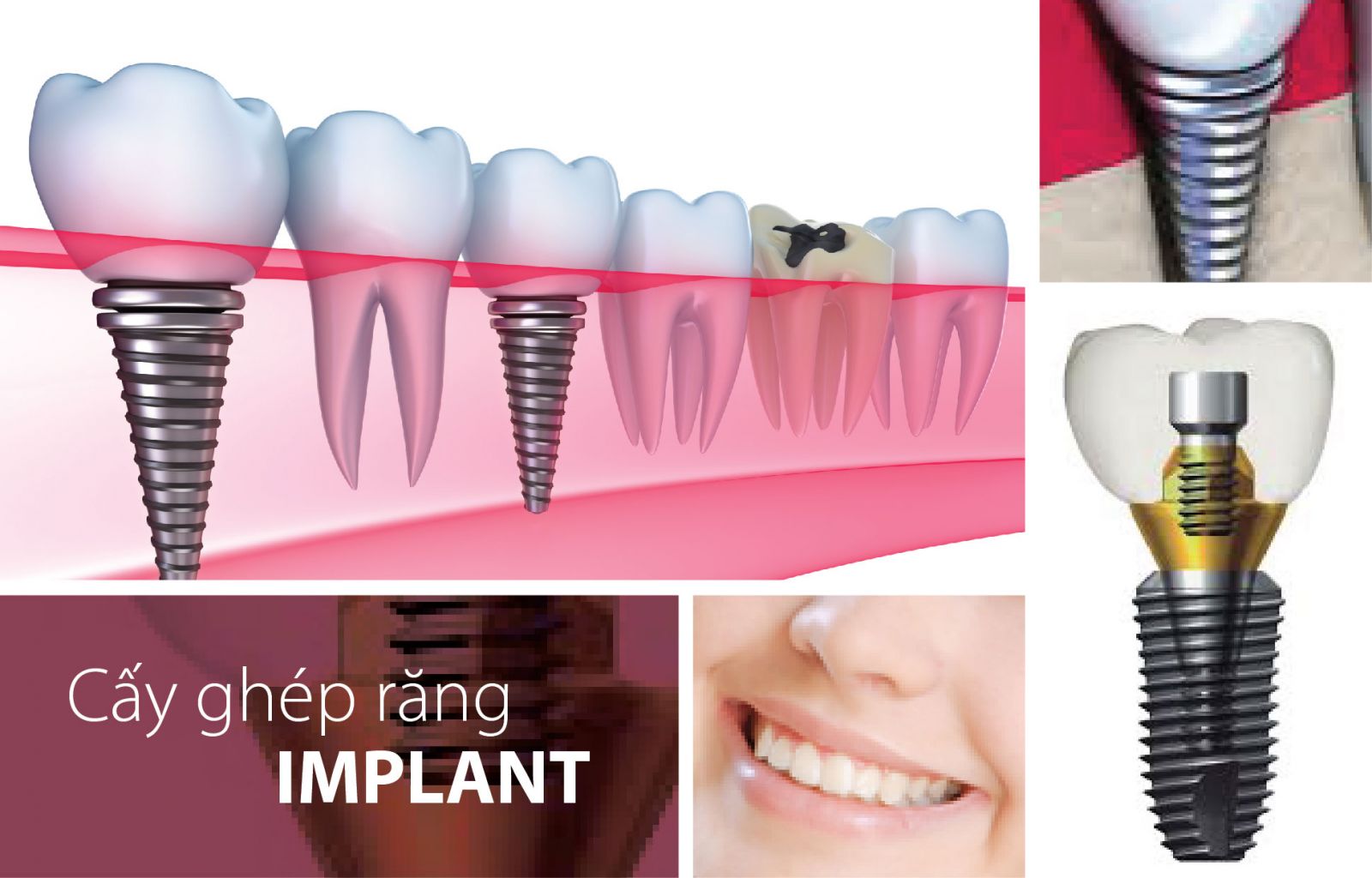 Phục hình răng Implant 4S giá bao nhiêu ?