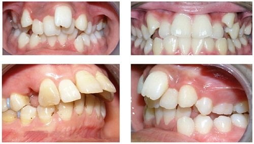 Niềng răng khấp khểnh mất bao lâu thì răng đều đặn? 1