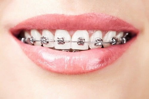 Giải pháp mới cho tình trạng răng mọc chen chúc