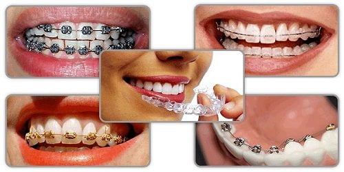 Niềng răng khấp khểnh mất bao lâu thì răng đều đặn? 3
