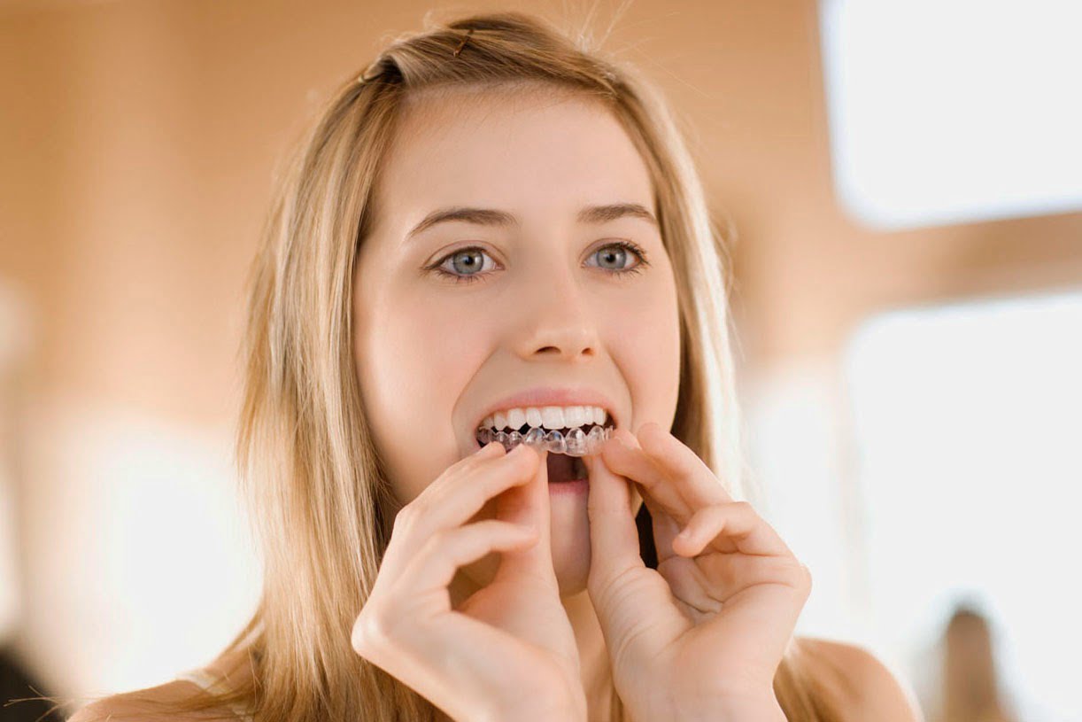 Quy trình niềng răng cho trẻ 
