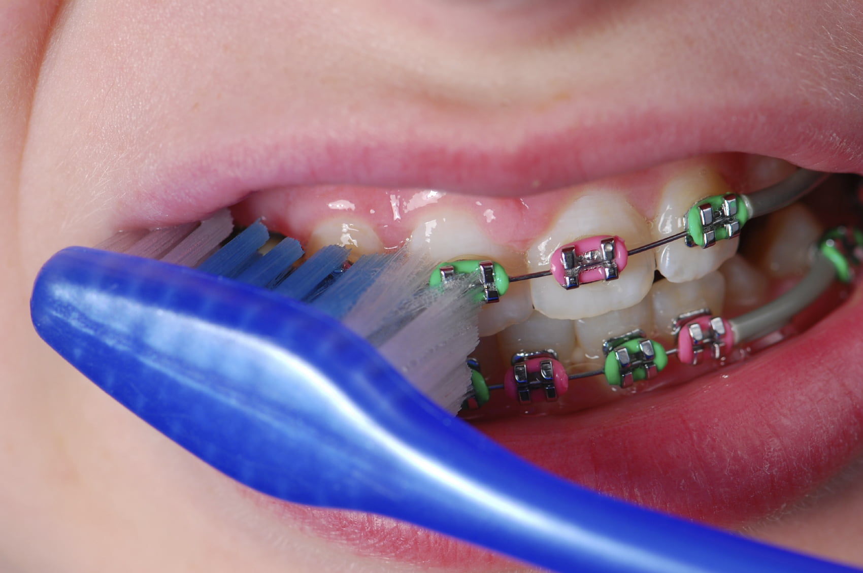 Quy trình niềng răng cho trẻ 