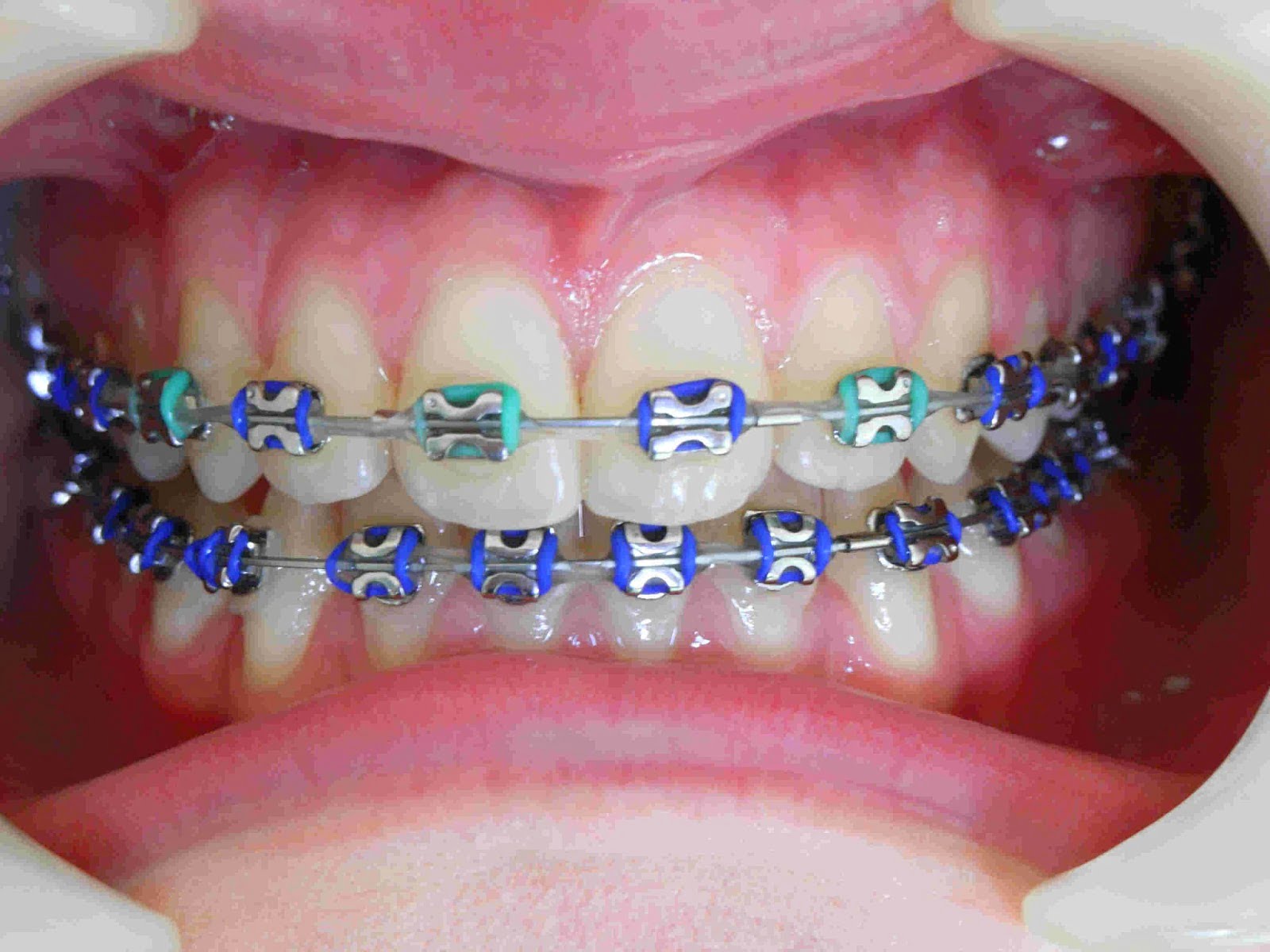 Răng bị vàng khi niềng răng không ?