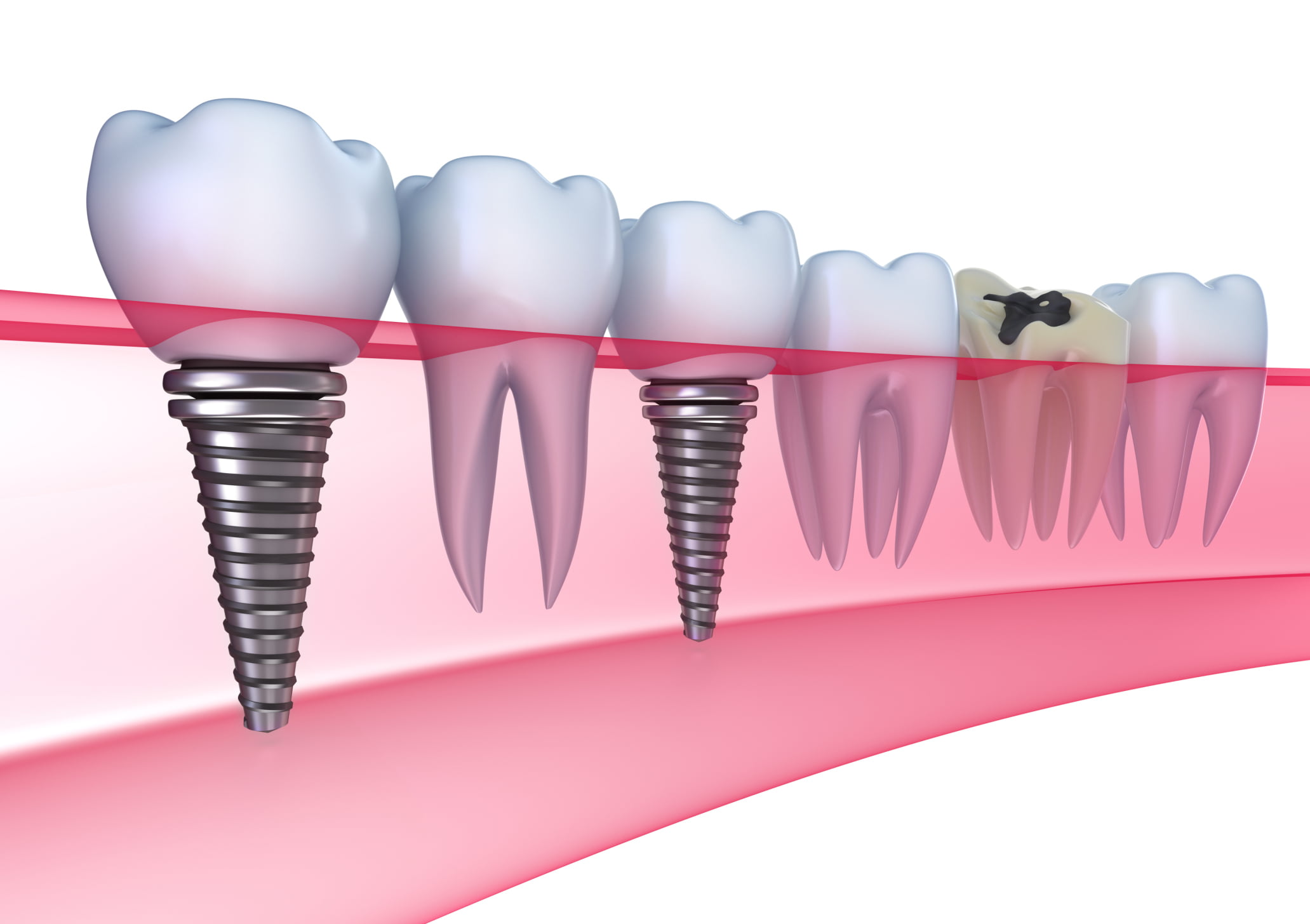 Cấy ghép implant khi mất toàn bộ răng