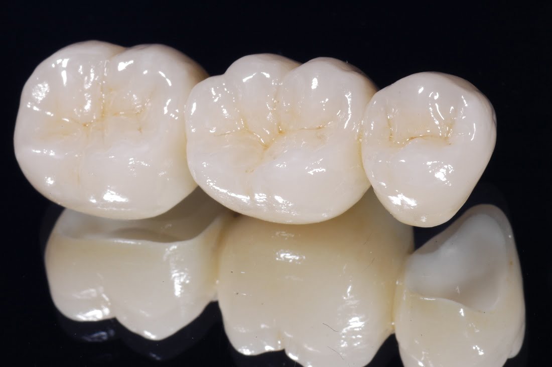 Bọc răng sứ Cercon duy trì được trong bao lâu ?