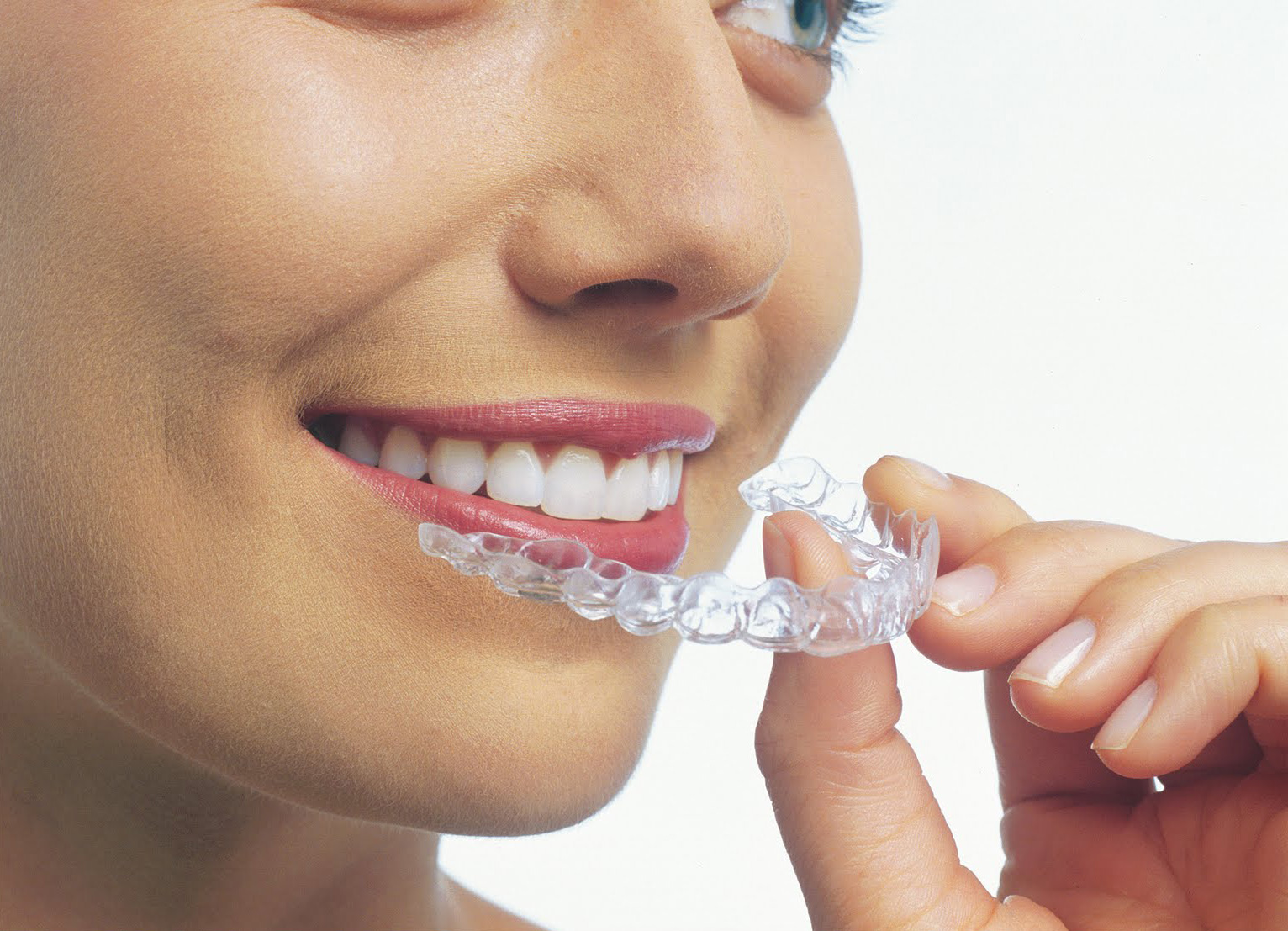 Quy trình niềng răng không mắc cài như thế nào ?