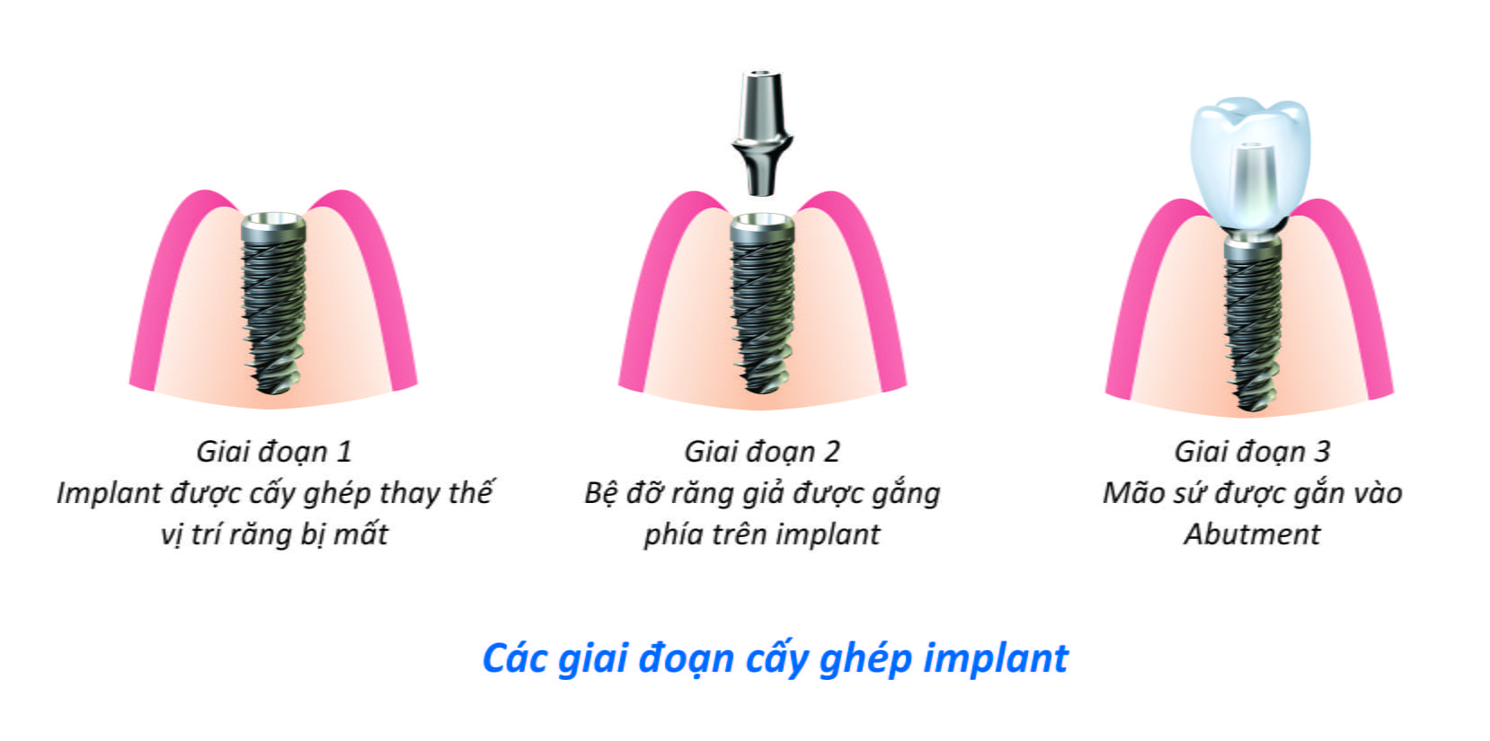 Răng implant tồn tại trong thời gian bao lâu ?