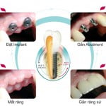 Trồng răng implant mất bao lâu ?