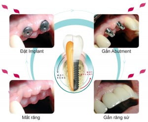 Trồng răng implant mất bao lâu ?