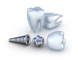 Chi phí cấy ghép răng implant giá bao nhiêu ?