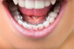 Niềng răng một hàm có được không ?