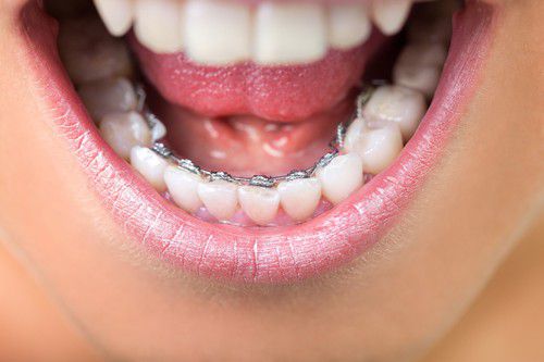 Chỉnh răng và điều cần lưu ý
