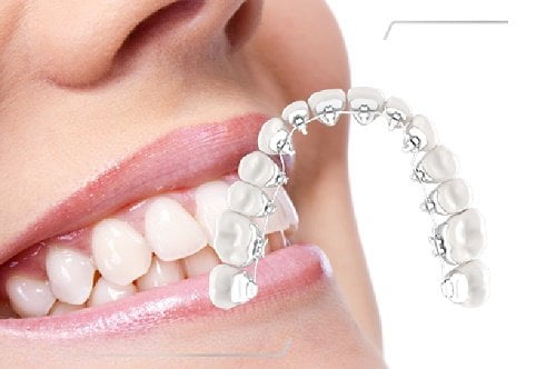 Niềng răng mặt trong cho hiệu quả cao 3