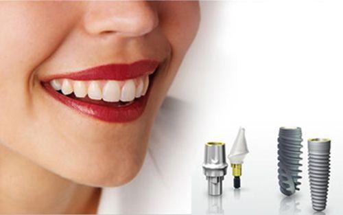 Cấy ghép răng Implant hiệu quả 1