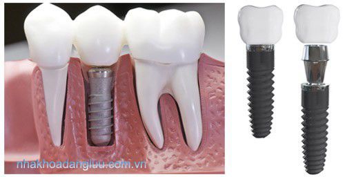Trồng răng Implant hết bao nhiêu tiền? 1