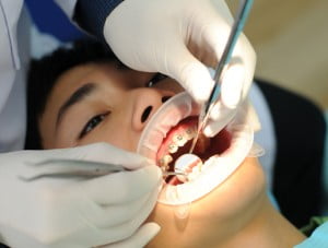Băn khoăn niềng răng có ảnh hưởng gì không ?
