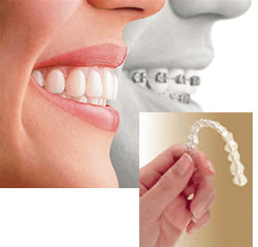 Những điều cần biết khi niềng răng bằng nhựa