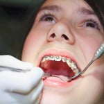 Nên niềng răng ở lứa tuổi nào ?