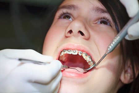 Quy trình niềng răng chuẩn và hiệu quả