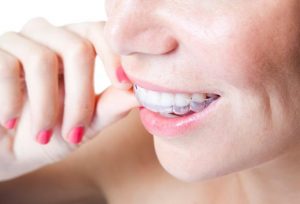invisalign