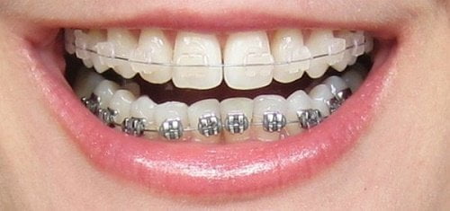 Niềng răng mất bao lâu thì hoàn thành? 1