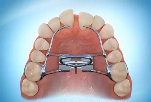 Tìm hiểu chỉnh nha tháo lắp có ốc nong rộng 1