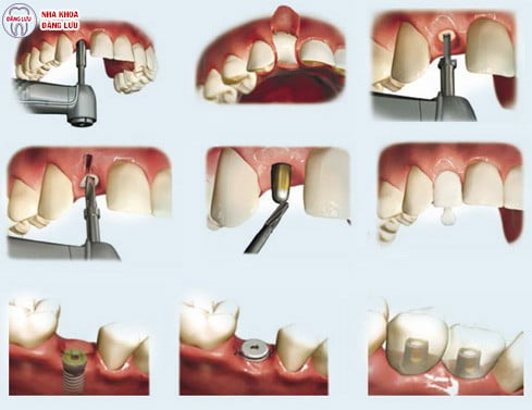 Cấy ghép răng implant  tiêu chuẩn quốc tế