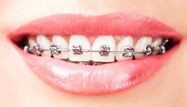5 loại niềng răng của nha khoa thế giới