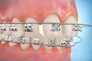 5 loại niềng răng của nha khoa thế giới