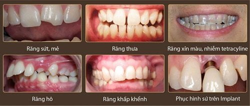 Bọc răng sứ cho răng khấp khểnh 1