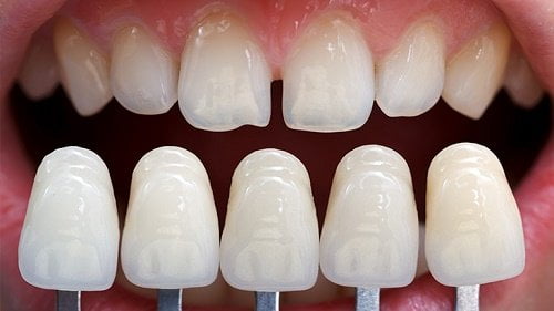 Bọc răng sứ cho răng khấp khểnh 3