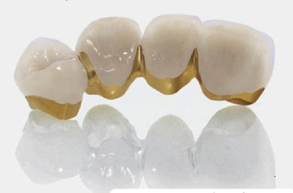 bọc răng sứ titan có ưu điểm gì