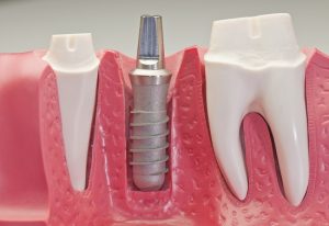 Cắm implant răng cửa được thực hiện như thế nào?