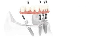 Cắm ghép răng implant hiệu quả an toàn