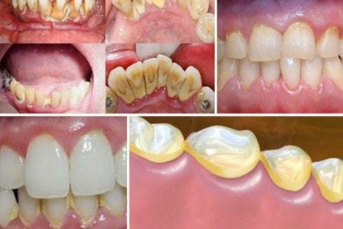 Cạo vôi răng có ảnh hưởng gì không? Giải đáp từ nha khoa 1