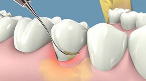 Cạo vôi răng có ảnh hưởng gì không? Giải đáp từ nha khoa 2