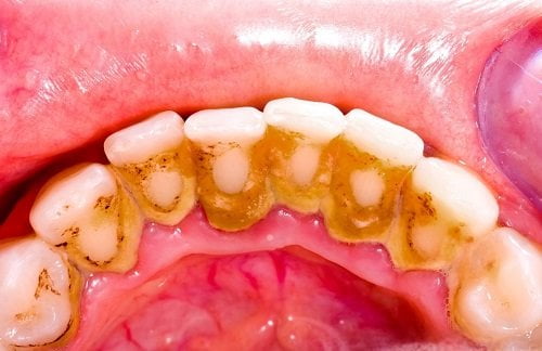 Cạo vôi răng có đau không? Giải đáp từ nha khoa 1