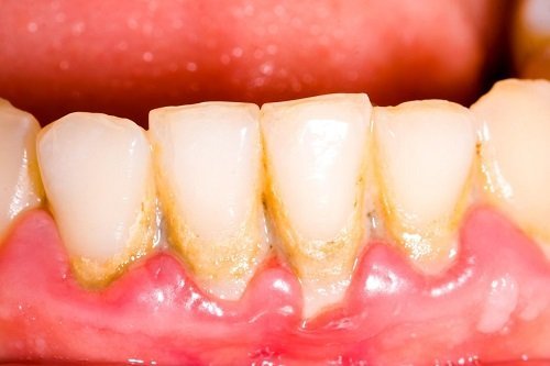 Cạo vôi răng có tốt không? Tìm hiểu chi tiết 1