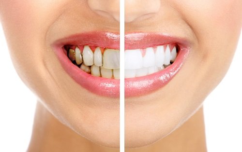 Cạo vôi răng có tốt không? Tìm hiểu chi tiết 3