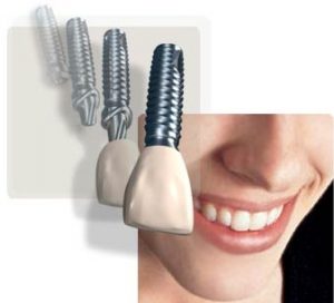 Chi phí làm răng giả cố định implant